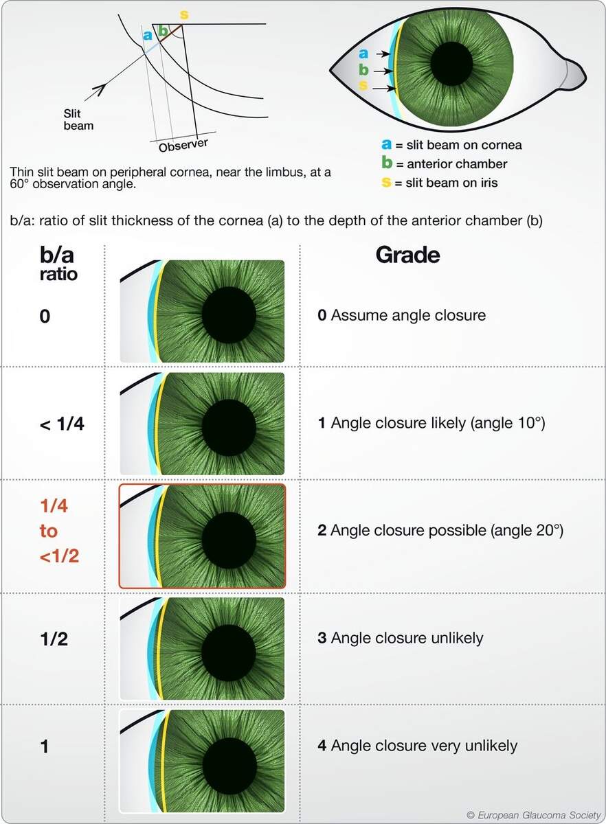 European Glaucoma Society Terminology And Guidelines For Glaucoma 6th Edition British Journal Of Ophthalmology European Glaucoma Society Terminology And Guidelines For Glaucoma 6th Edition British Journal Of Ophthalmology