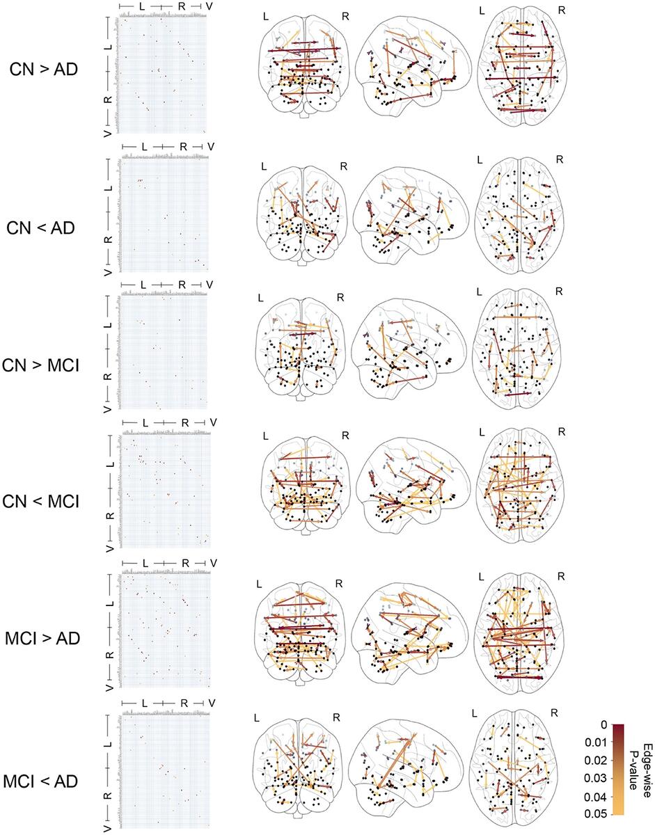 Frontiers Causal Functional Connectivity In Alzheimer S Disease Computed From Time Series FMRI Data